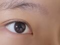 一毫米 金洪振院长  埋线双眼皮 术后反馈