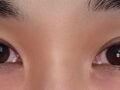 埋线双眼皮修复  术后反馈