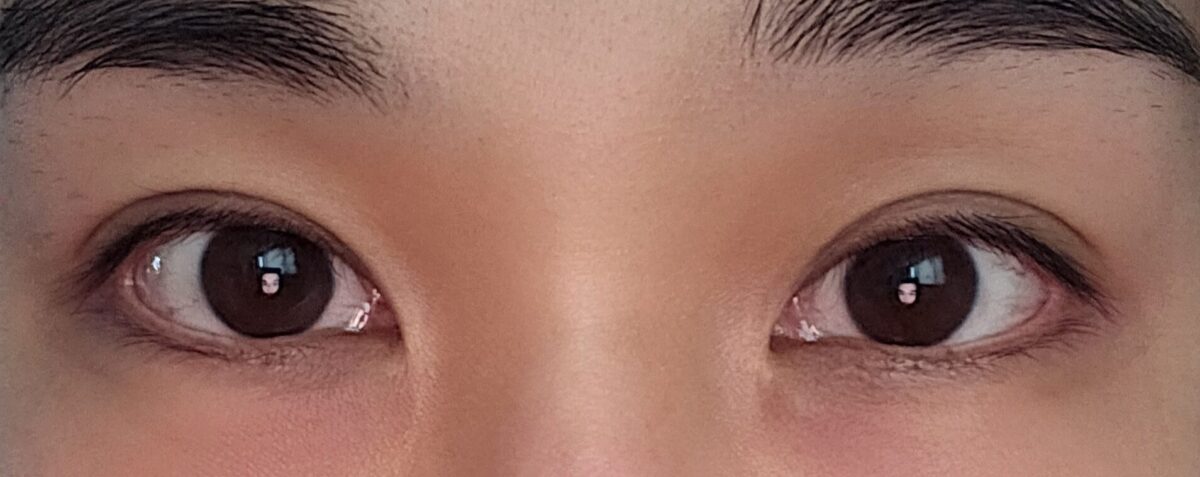 自然癒着再手術のレビュー！