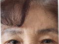 75岁  埋线双眼皮 术后反馈