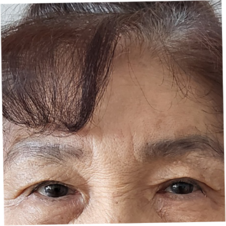 75歳非切開二重まぶたレビュー