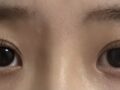 รีวิวการผ่าตัดตาครั้งแรกของฉันกับผู้กำกับโด ออน-ร็อก