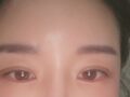 การยึดเกาะตามธรรมชาติ การปลูกถ่ายไขมันบนใบหน้า