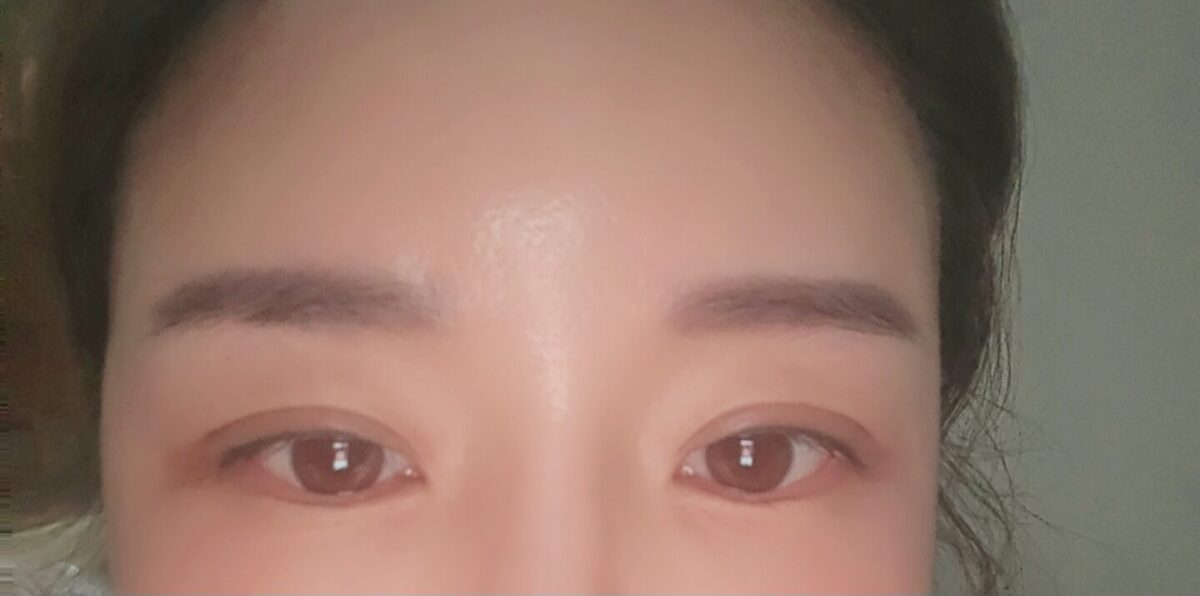 自然癒着、顔脂肪移植