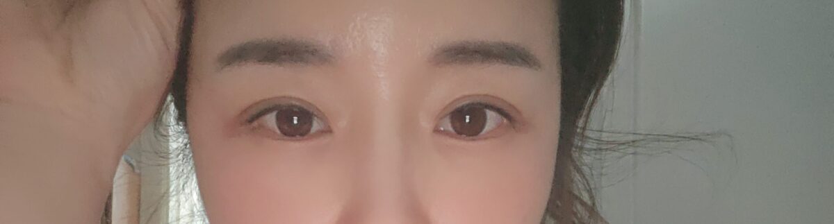 自然粘连+上眼角 