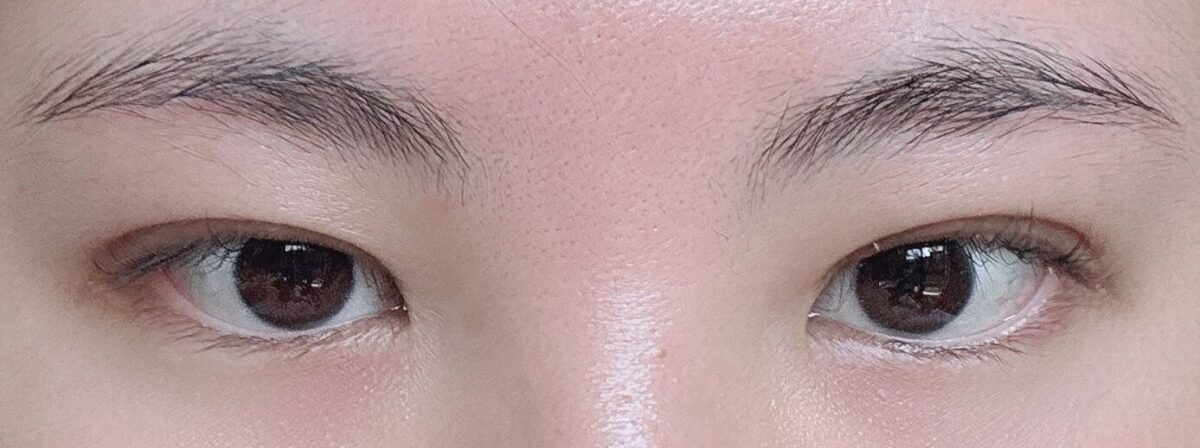 都彦禄院长   双眼皮修复