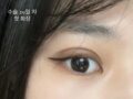 全切双眼皮修复  都彦禄院长   术后反馈