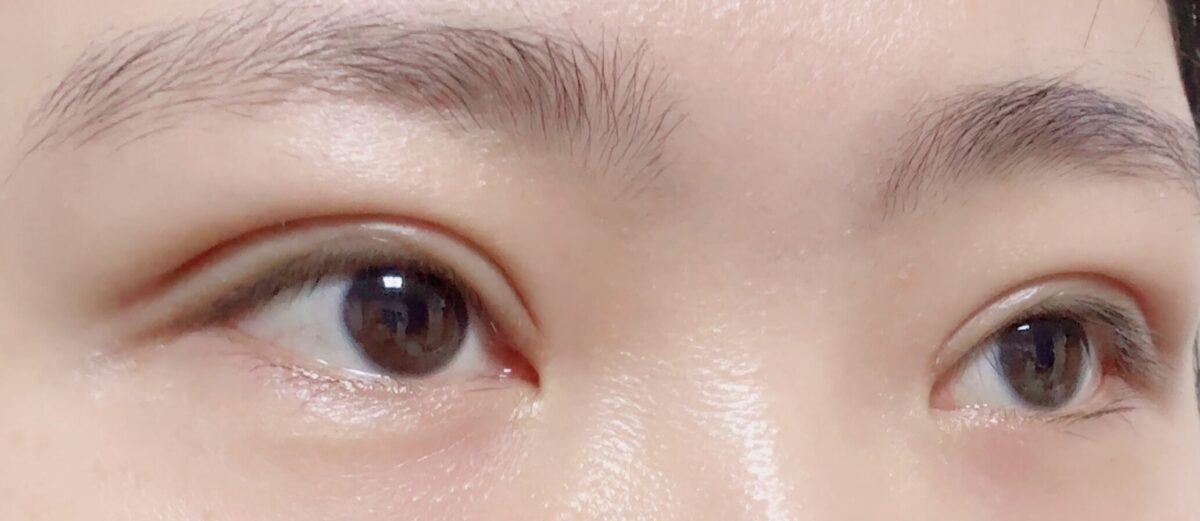 รีวิวการผ่าตัดทำตาสองชั้น (เย็บซ่อนไหม)