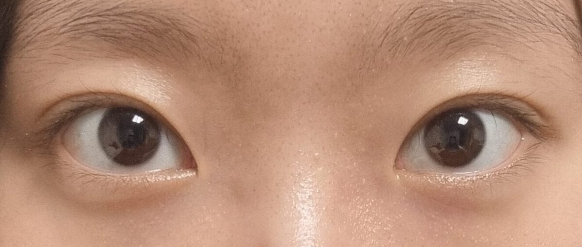自然粘连双眼皮反馈