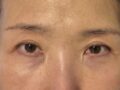 切眉提升 术后反馈