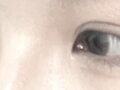 การผ่าตัดตาของ ดร.คิม ฮงจิน