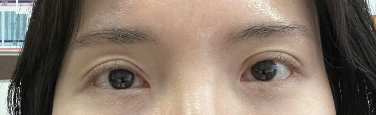 双眼皮修复+上眼角+提肌