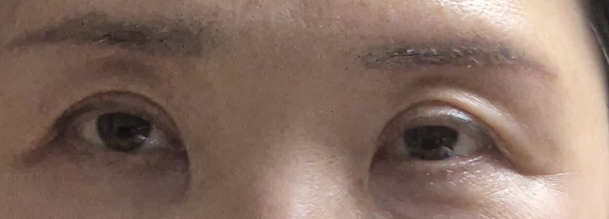 切眉提升