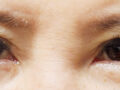 การจัดตำแหน่งไขมันใต้ตาใหม่ โดยหัวหน้าศัลยแพทย์ โด ออน-ร็อก ที่ 1mm Plastic Surgery