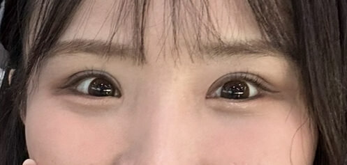 眼科手術のレビュー