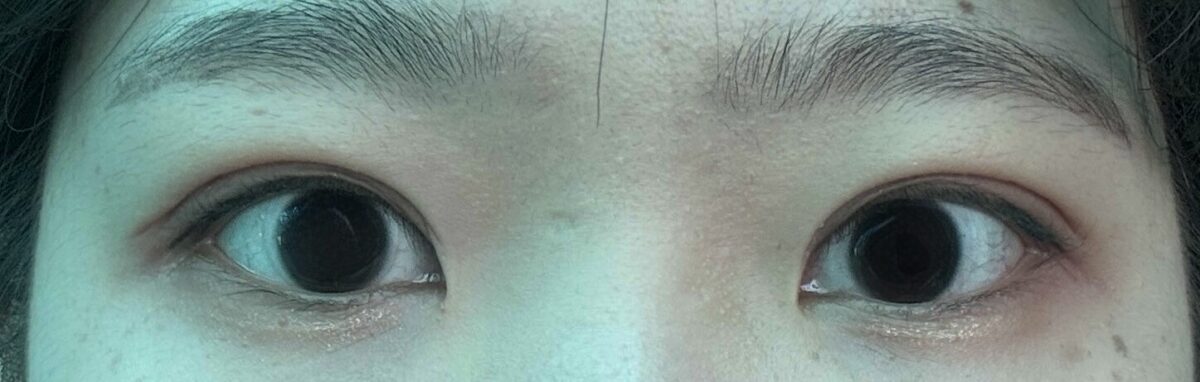 รีวิวการผ่าตัดทำตาสองชั้นของ ดร.คิม ฮงจิน