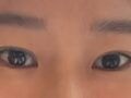 日ミリペアカプル切開再手術のレビュー