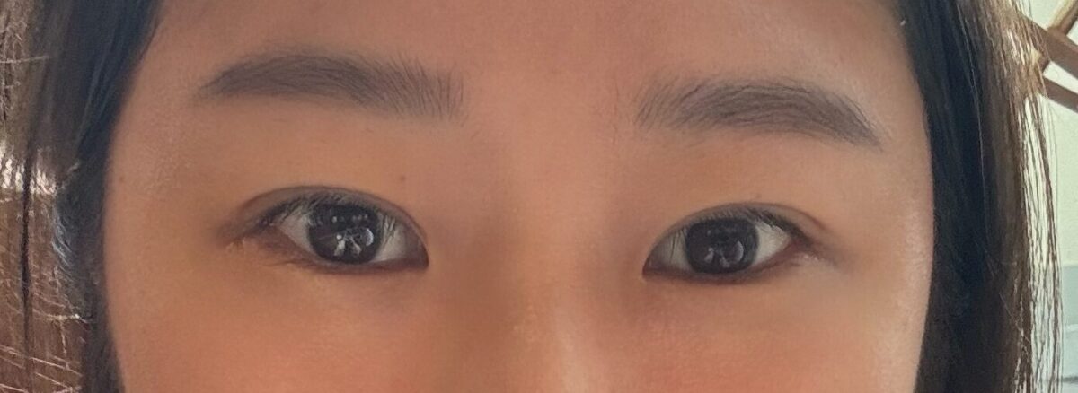รีวิวการผ่าตัดแก้ไขเปลือกตาสองชั้นด้วยแผลผ่าตัดขนาด 1 มม.