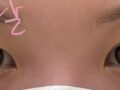 รีวิวการยกกระชับเปลือกตาบนด้วยวิธี Natural Adhesion ร่วมกับการดูแลจากผู้อำนวยการคิม ฮงจิน ที่คลินิก Ilmiri :)