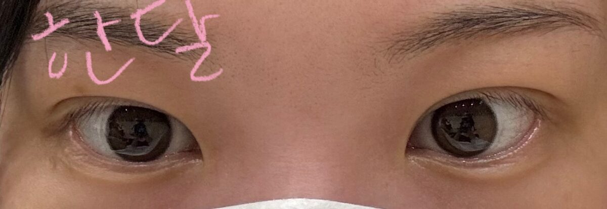 รีวิวการยกกระชับเปลือกตาบนด้วยวิธี Natural Adhesion ร่วมกับการดูแลจากผู้อำนวยการคิม ฮงจิน ที่คลินิก Ilmiri :)