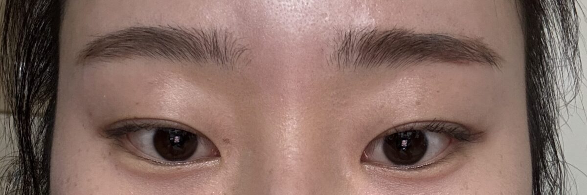 都彦禄院长 实施的自然粘连+内眦成形术