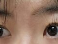รีวิวการผ่าตัดตาโดย ดร. คิม ฮงจิน จาก Ilmiri