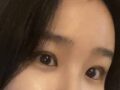金洪振院长 双眼皮手术后反馈