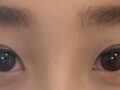 二重まぶた自然癒着再手術のレビュー