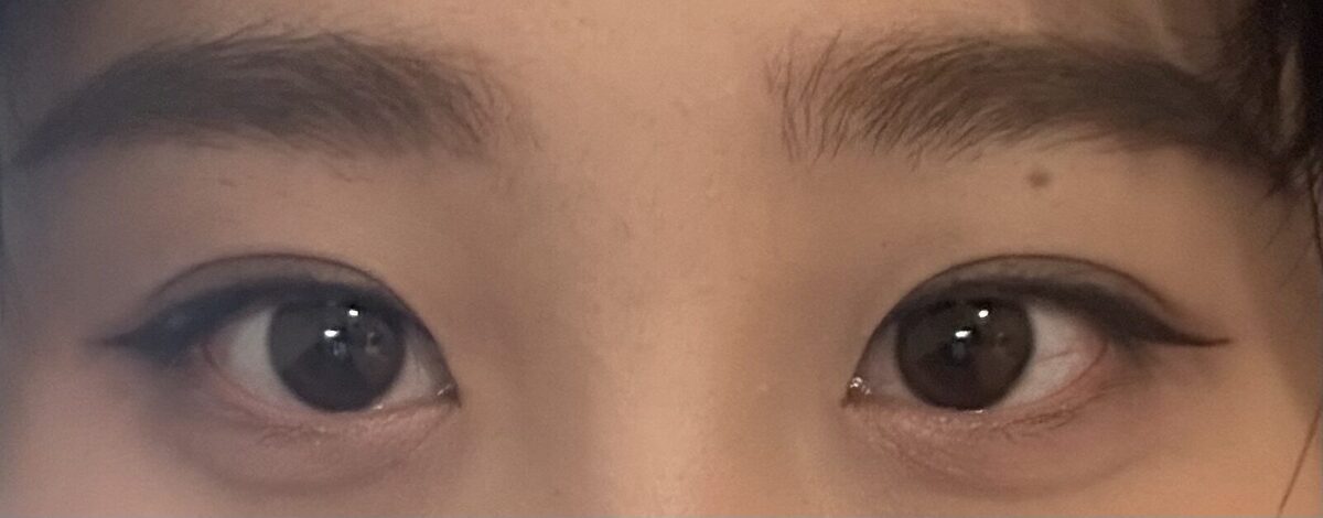 二重まぶた自然癒着再手術のレビュー