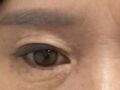 一目眉毛上術＆切開二重まぶた後期（キム・ホンジン院長）