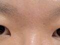 การยึดเกาะตามธรรมชาติ 1 มม.