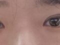 ผ่านมา 3 เดือนแล้วนับตั้งแต่ฉันเข้ารับการผ่าตัดตกแต่งหัวตาและผ่าตัดสร้างชั้นตาซ้อนโดยศัลยแพทย์คิม ฮงจิน