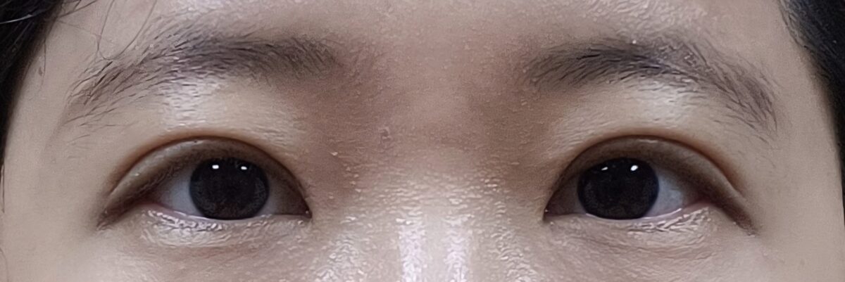 イルミリーキム・ホンジン院長の目再手術のレビュー！