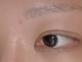 一毫米 都彦禄院长   自然粘连+上眼角  术后1.5个半月 反馈