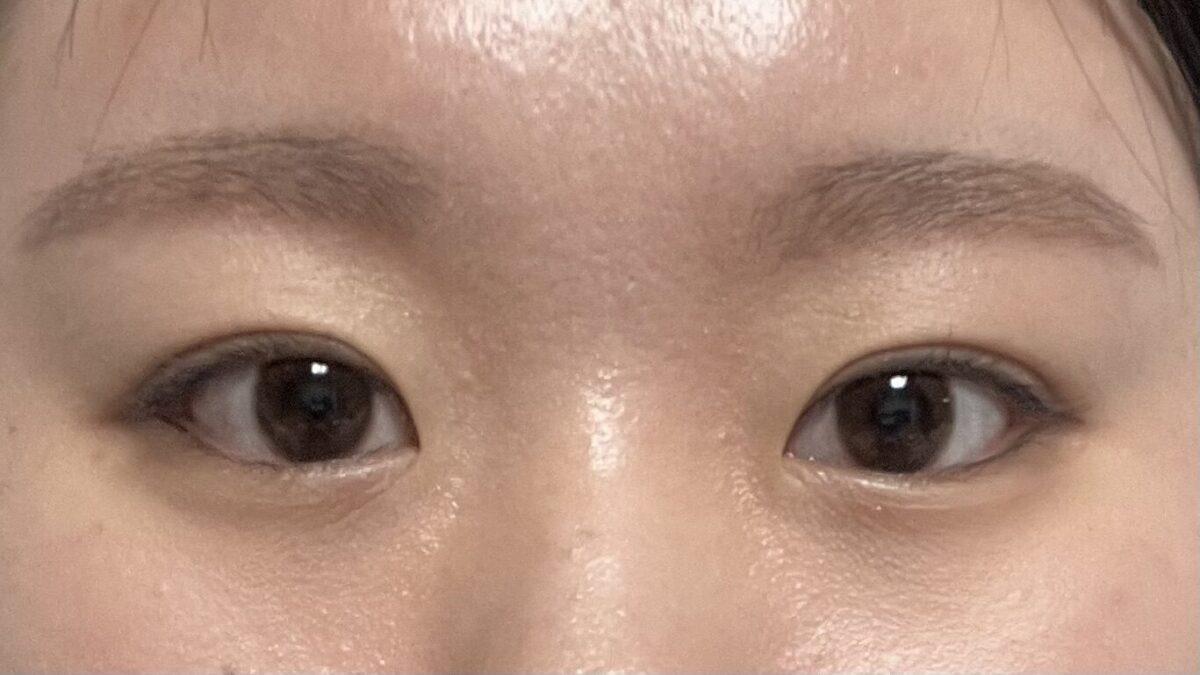 一毫米  自然粘连双眼皮