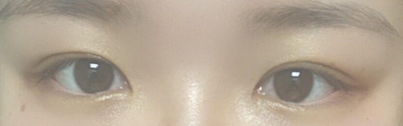 ดร. โด วอน-ร็อก อิลมิริ / ศัลยกรรมตกแต่งเปลือกตาแบบเปิด + การแก้ไขเปลือกตา / รีวิวพึงพอใจอย่างมาก!!!!!!!!!!
