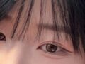 3 เดือนหลังการผ่าตัดยกกระชับเปลือกตาบนและเปลือกตาสองชั้นแบบไม่ต้องกรีด (โดย ดร. คิม ฮงจิน)