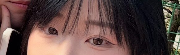 3 เดือนหลังการผ่าตัดยกกระชับเปลือกตาบนและเปลือกตาสองชั้นแบบไม่ต้องกรีด (โดย ดร. คิม ฮงจิน)