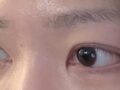 一毫米  都彦禄院长- 自然粘连+上眼角  3.5个半月 术后反馈