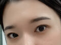 一毫米 都彦禄院长  双眼皮修复+上眼角  反馈