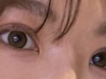 一毫米都彦禄院长 双眼皮修复反馈