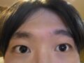 イルミリ切開術後