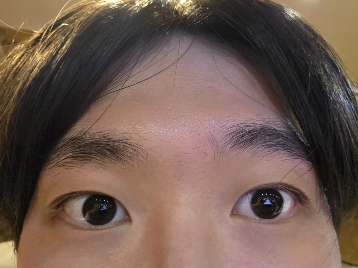 一毫米 全切双眼皮术后反馈