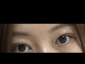 การแก้ไขเปลือกตาด้วยการผ่าตัดเพียง 1 มม. โดยผู้อำนวยการ คิม ฮงจิน