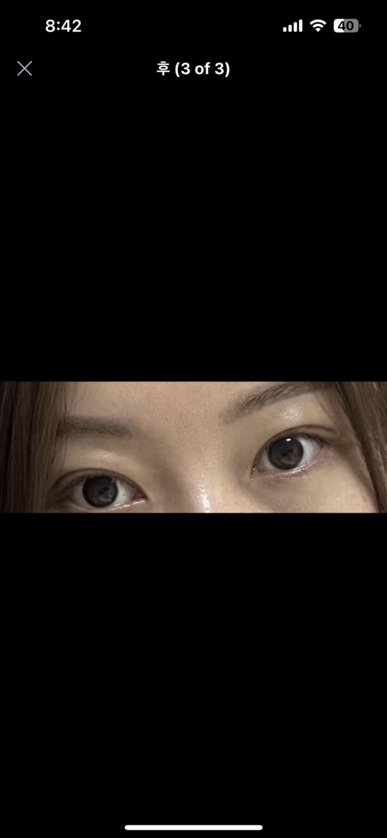 การแก้ไขเปลือกตาด้วยการผ่าตัดเพียง 1 มม. โดยผู้อำนวยการ คิม ฮงจิน