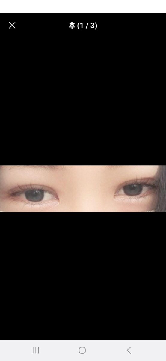 วิธีการเย็บแผล 1 มม. โดยผู้อำนวยการคิม ฮงจิน