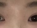 รีวิวการผ่าตัดทำตาสองชั้นของ ดร.โด ออน-ร็อก