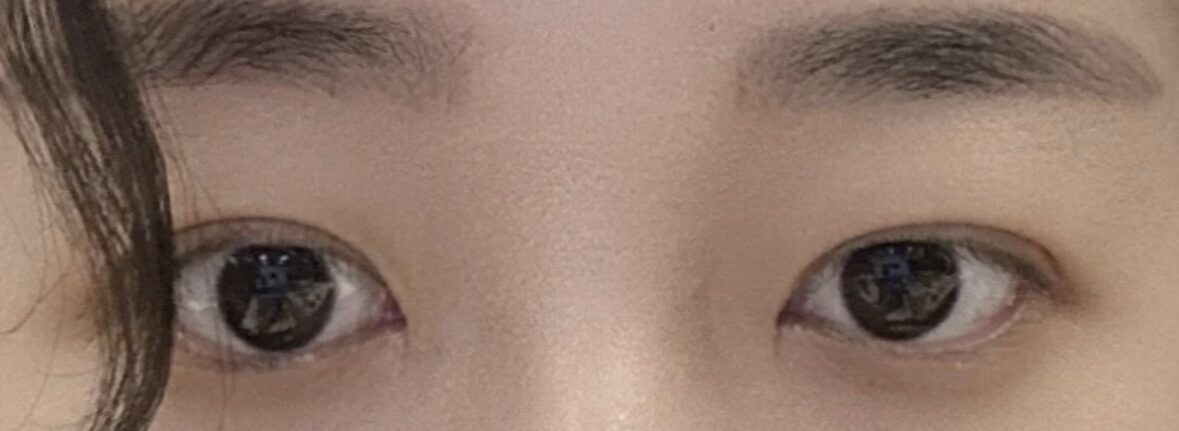 一毫米 自然粘连+前眼角+上眼角