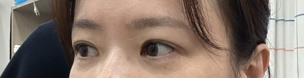 イルミリードアンロック院長の自然癒着双子手術後期です