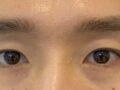 รีวิวการผ่าตัดแบบไม่ต้องกรีดแผลของ ดร.โด ออน-ร็อก!